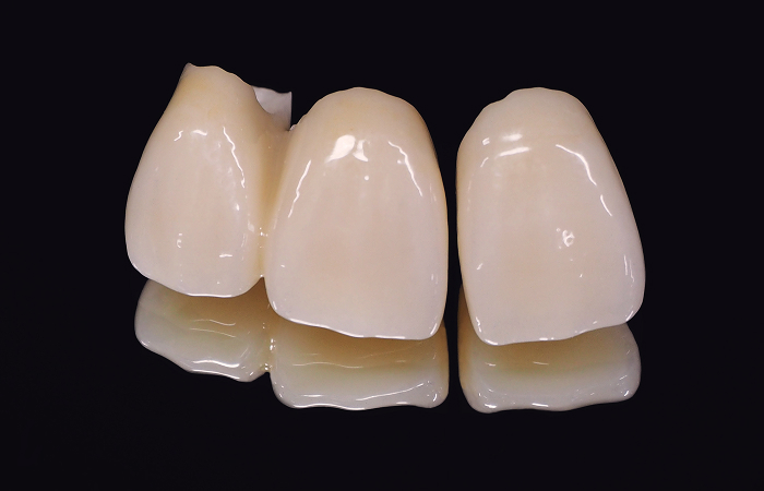 オールセラミッククラウン