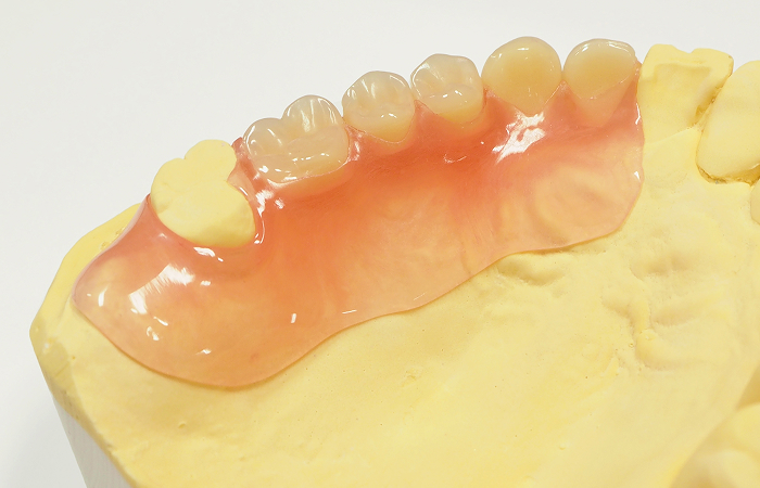 ノンクラスプデンチャー