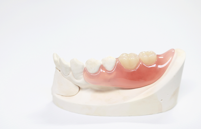 ノンクラスプデンチャー