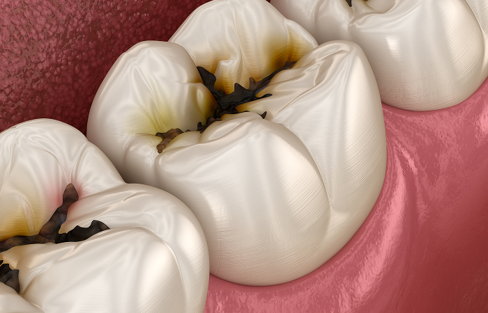 むし歯とはどのようなものですか？