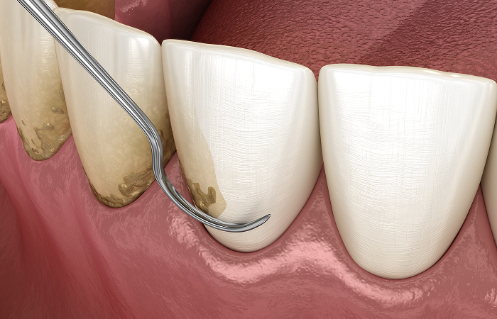 歯周病の原因と治療法は？