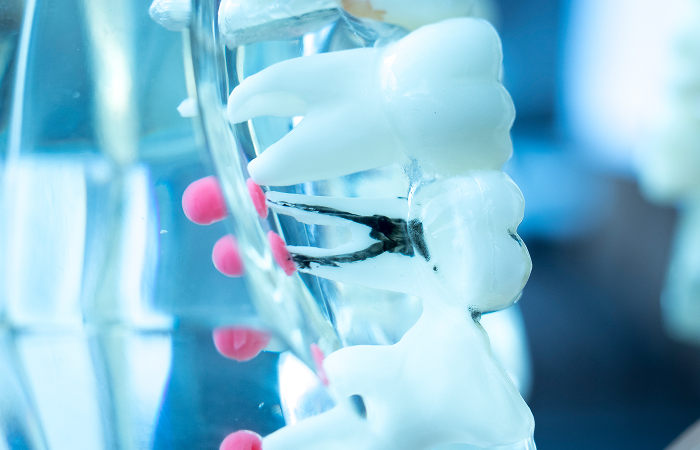 根管治療とは？