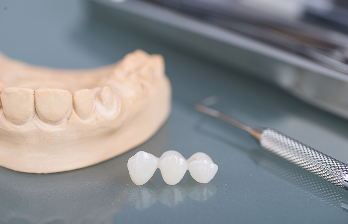 インプラント体の素材について