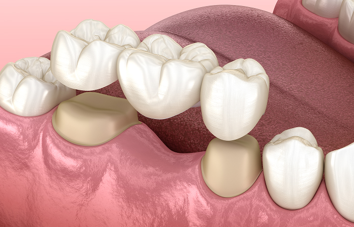 ブリッジとの違い