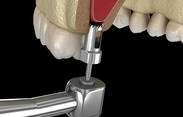 インプラント用ドリル