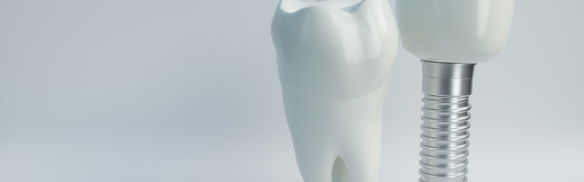 インプラント