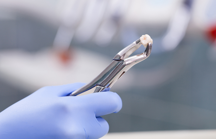 口腔外科・親知らず治療について