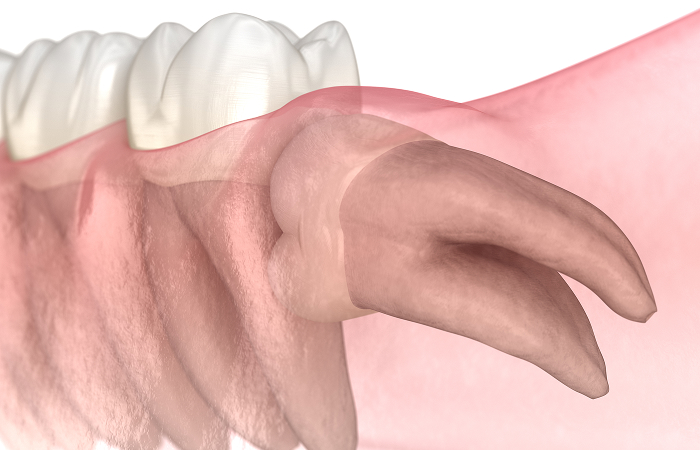 歯並びへの影響