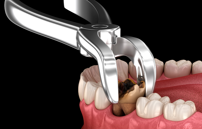 むし歯のリスク