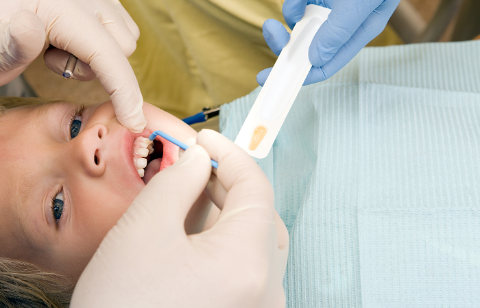 フッ素（フッ化物）塗布