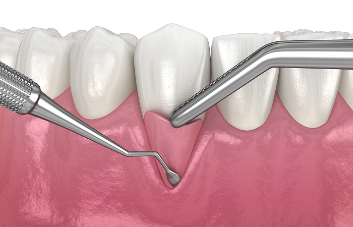 再生療法の実施