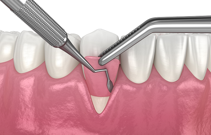 歯周再生治療とは