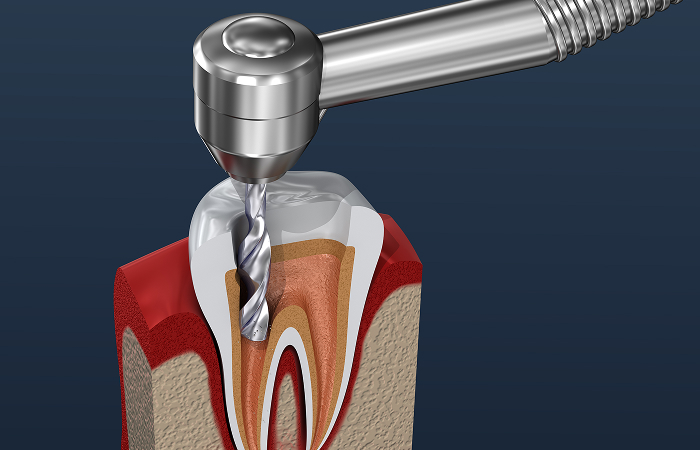 歯髄（神経）まで歯を削る