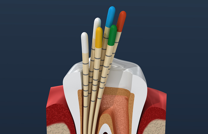 根管の洗浄・消毒