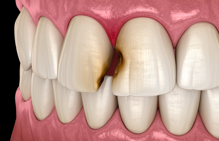 むし歯はどうして起こるのか