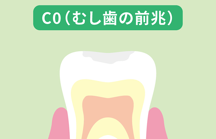 初期むし歯（CO）