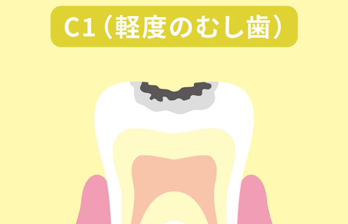 エナメル質のむし歯（C1）