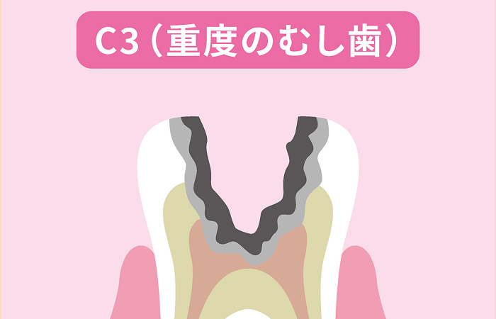 神経まで進行したむし歯（C3）