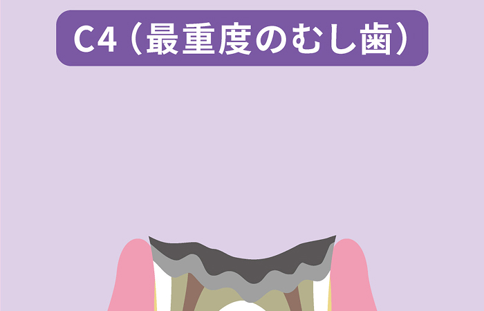 歯根だけ残ったむし歯（C4）