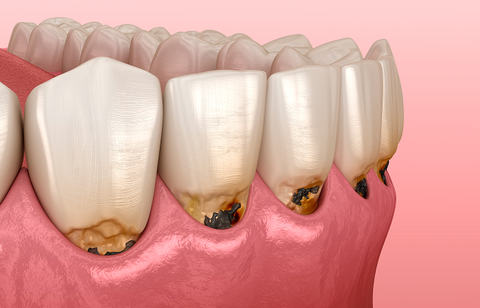 大人のむし歯の特徴