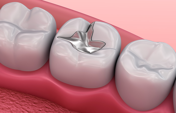 保険診療のむし歯治療