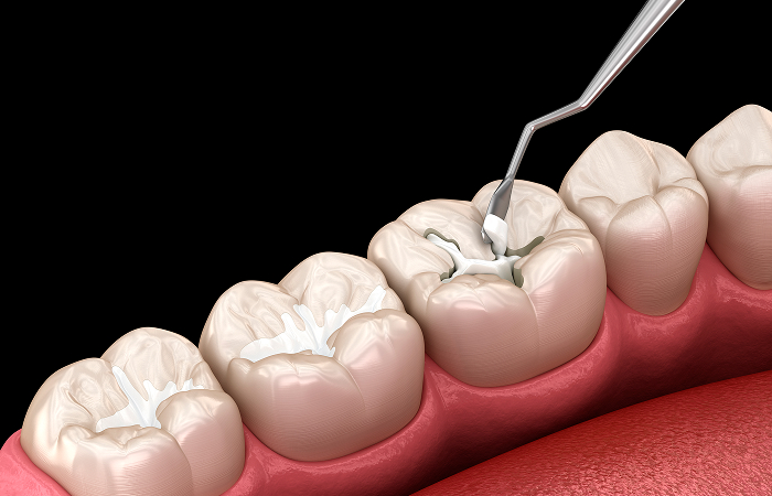 自由診療のむし歯治療